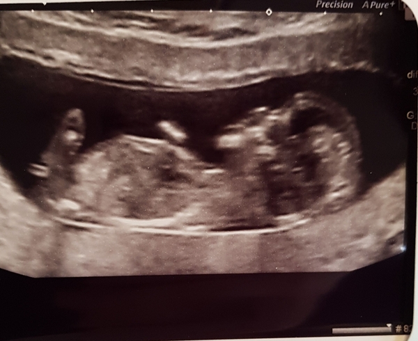 Boy or Girl? I Have My Gender Scan Sunday!