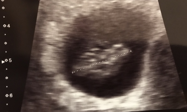 Scan at 7 weeks