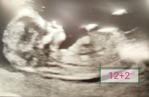 20 week scan - sonographer couldn't determine the sex!