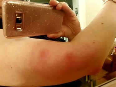 Mosquito bites from Hell....