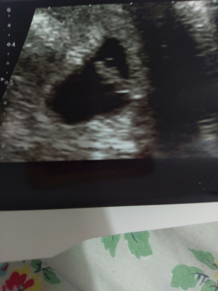 Scan at 7 weeks
