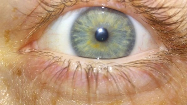 Eye colour