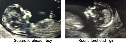 20 week scan - sonographer couldn't determine the sex!