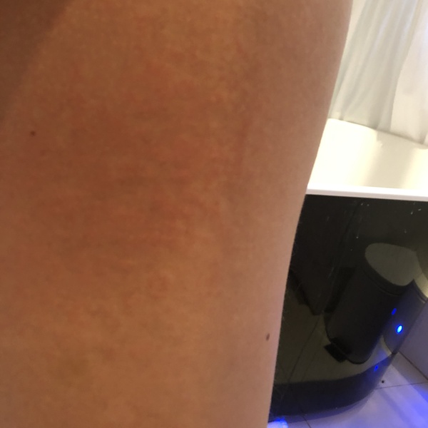 Please help! What is this rash?!