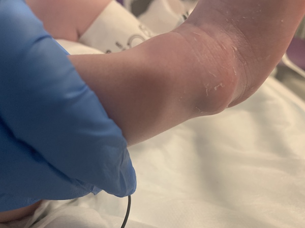 Hard lumps on babes ankle / foot