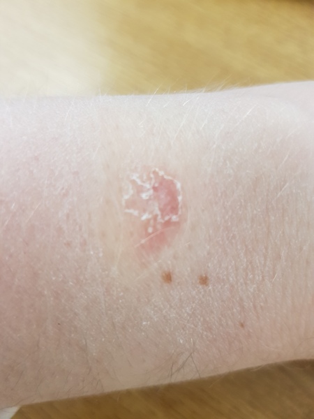 Fitbit burn?!