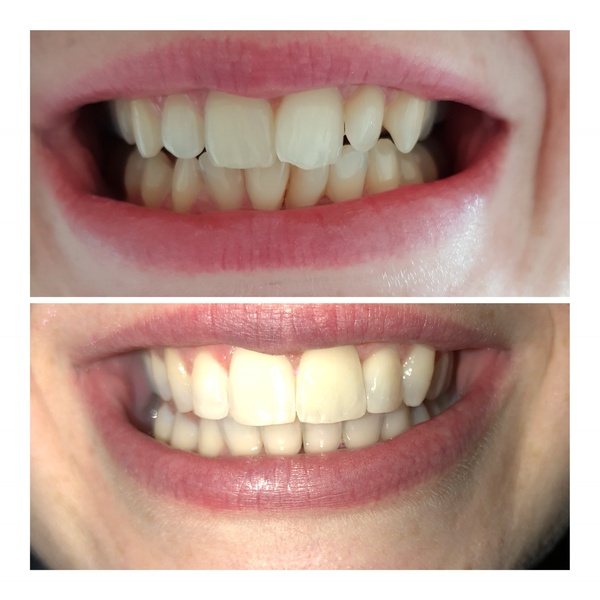 Invisalign- tell me to woman up!