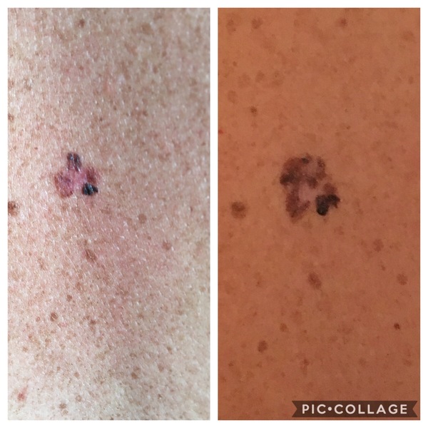 Anyone had a mole investigated?  GP has referred me to hospital.