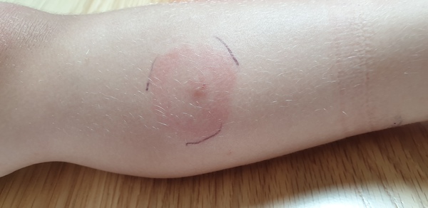 To think this is lymes disease (with pic)