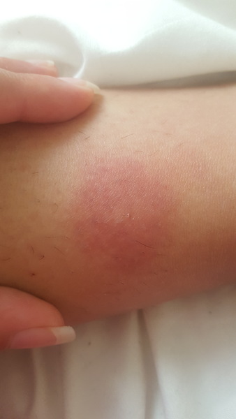 What kind of bite does this look like?
