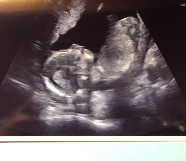 Gender guess! Just for fun until re scan Tuesday!