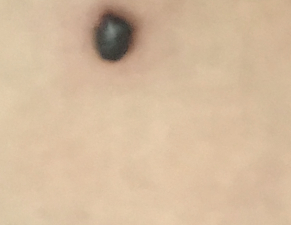Sudden mole on back of thigh