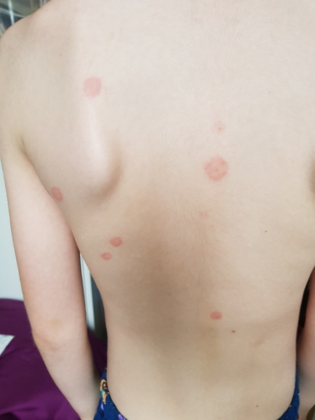 To think this is lymes disease (with pic)