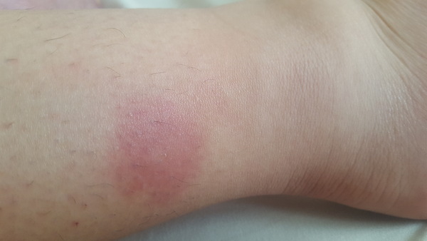 What kind of bite does this look like?