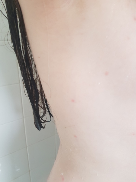 chicken pox or just an odd rash?