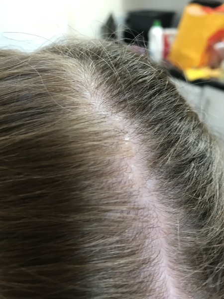 Any ideas what this is on my 9 year olds scalp?- photo