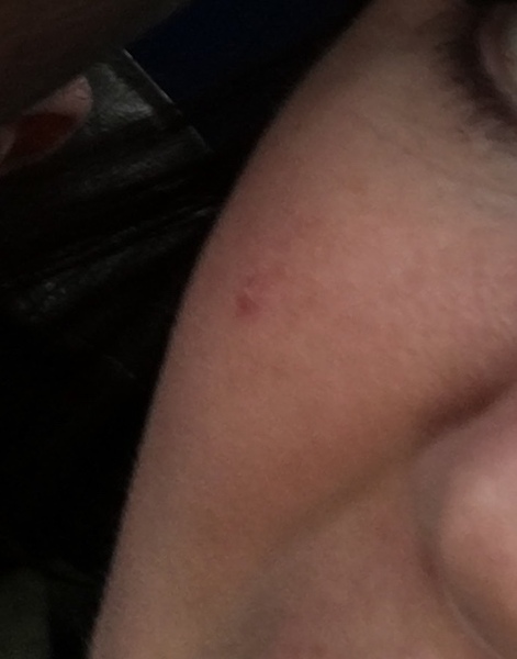 Is this cystic acne?