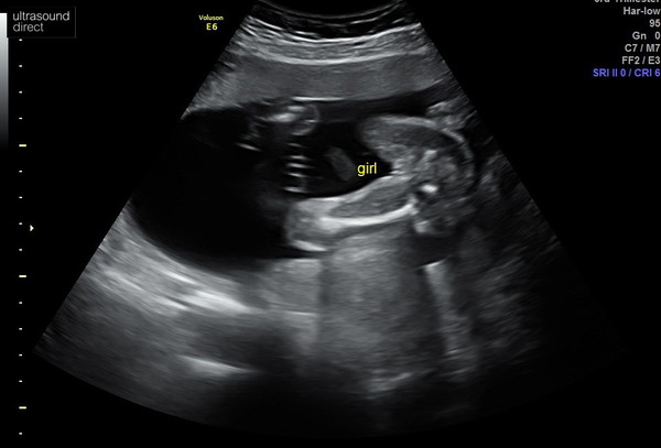 20 week scan - sonographer couldn't determine the sex!