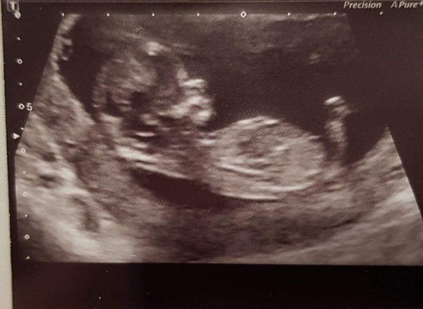 Can anyone guess sex of baby?