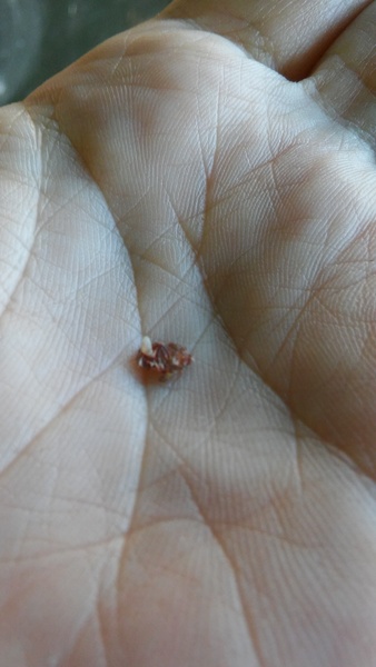 I pulled something weird out of my back (pic included)