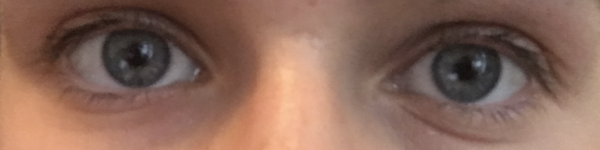 Deep line under eye