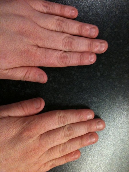 To ask how you stopped nail biting