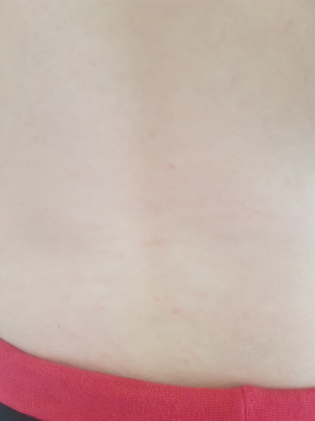 chicken pox or just an odd rash?