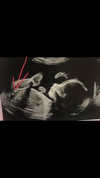 Has scan at 23 weeks given baby’s sex away?