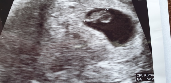 The Graduates of TTC after pregnancy loss thread