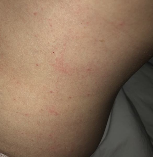 What has bitten me - I’m covered!