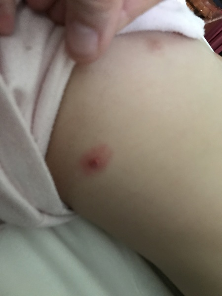 Skin tag or molluscum scratched accidentally