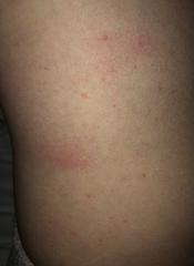What has bitten me - I’m covered!