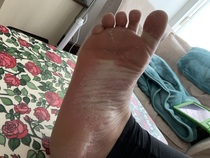 It has begun...... warning this post is about peeling skin