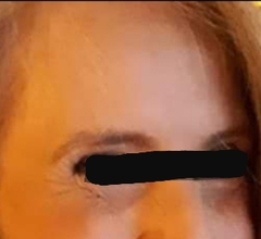I got Botox today for the first time