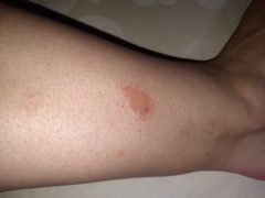 What is this itchy mark on my leg?