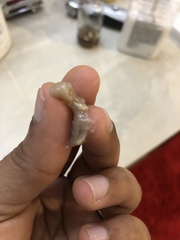 Brown Discharge at 16 weeks