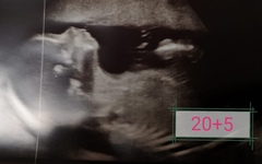 20 week scan - sonographer couldn't determine the sex!