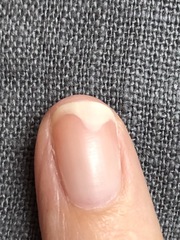 Nail lifting from bed after mani!!