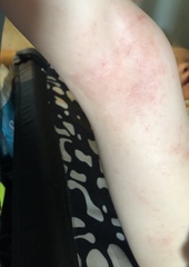 Is this eczema, an allergy or rash?