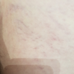 Early stretchmarks or something else?