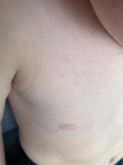 Chicken Pox in a vaccinated child