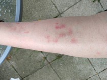 To ask if you recognise this rash?