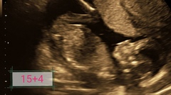 20 week scan - sonographer couldn't determine the sex!