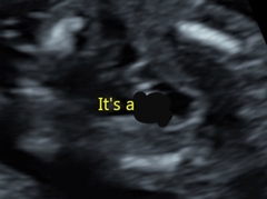 Just had a private gender scan at 16+2 weeks! What do you think?...