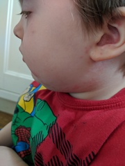 MMR side effects?