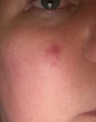 Is this cystic acne?