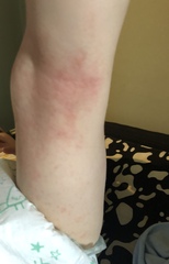 Is this eczema, an allergy or rash?
