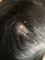 Dry flakey bald patch