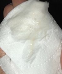 TMI PICS. Bleeding 5dpo