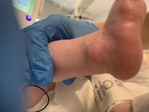 Hard lumps on babes ankle / foot
